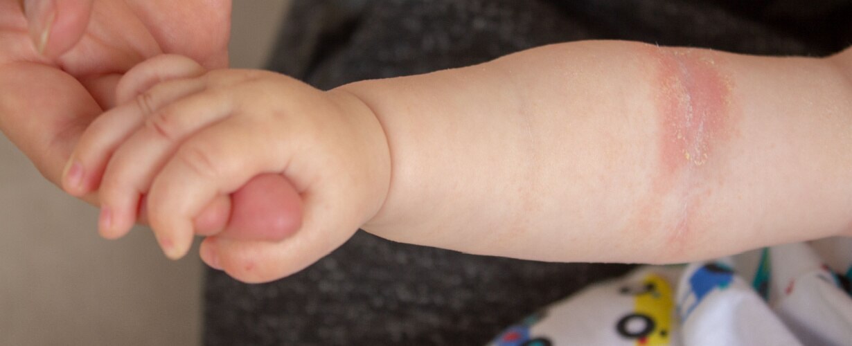 Consejos para el cuidado de la piel atópica en tu hijo