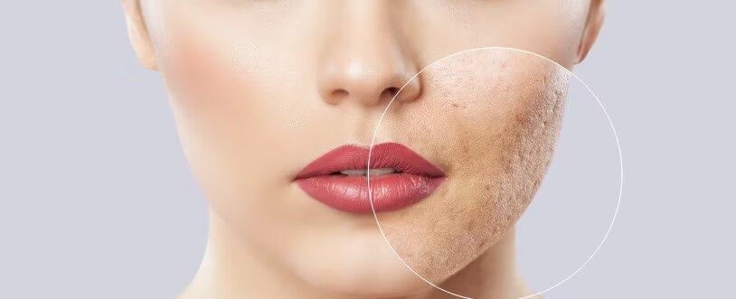 ¿Qué es el maskne y cómo evitarlo?